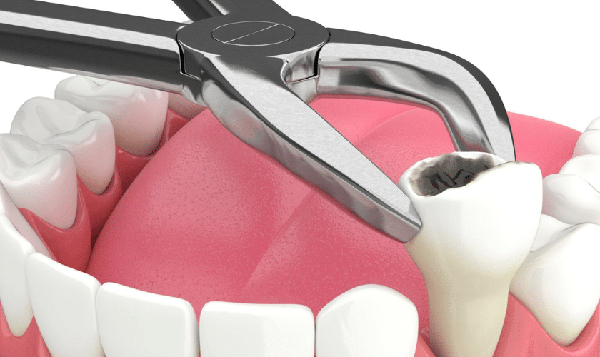 Tooth Extraction