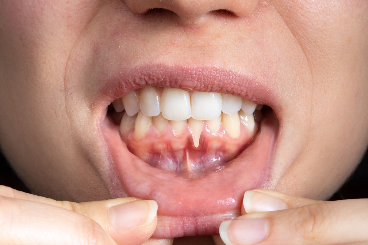 Periodontal Disease