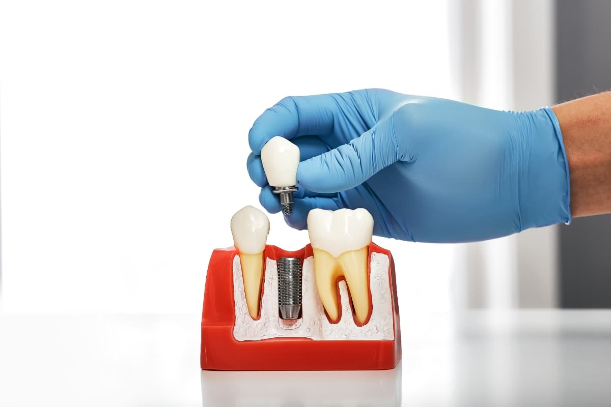 dental implants in Bridgeville