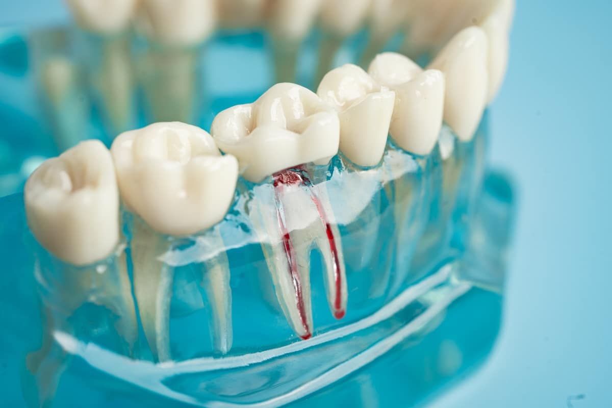 root canals in Bridgeville